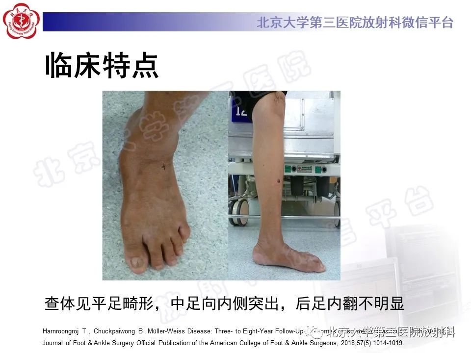 影像PPT - 【PPT】足舟骨缺血坏死-26