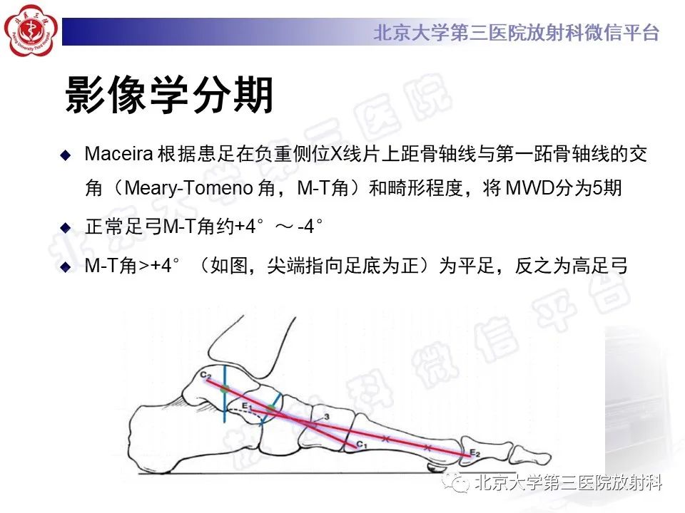 影像PPT - 【PPT】足舟骨缺血坏死-28