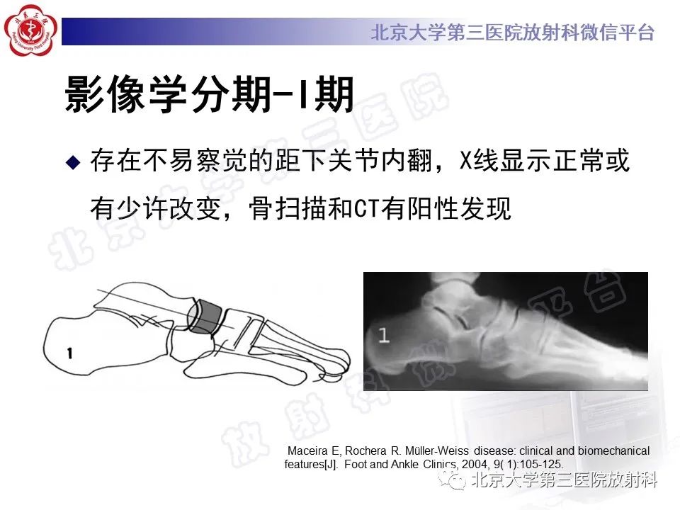 影像PPT - 【PPT】足舟骨缺血坏死-29