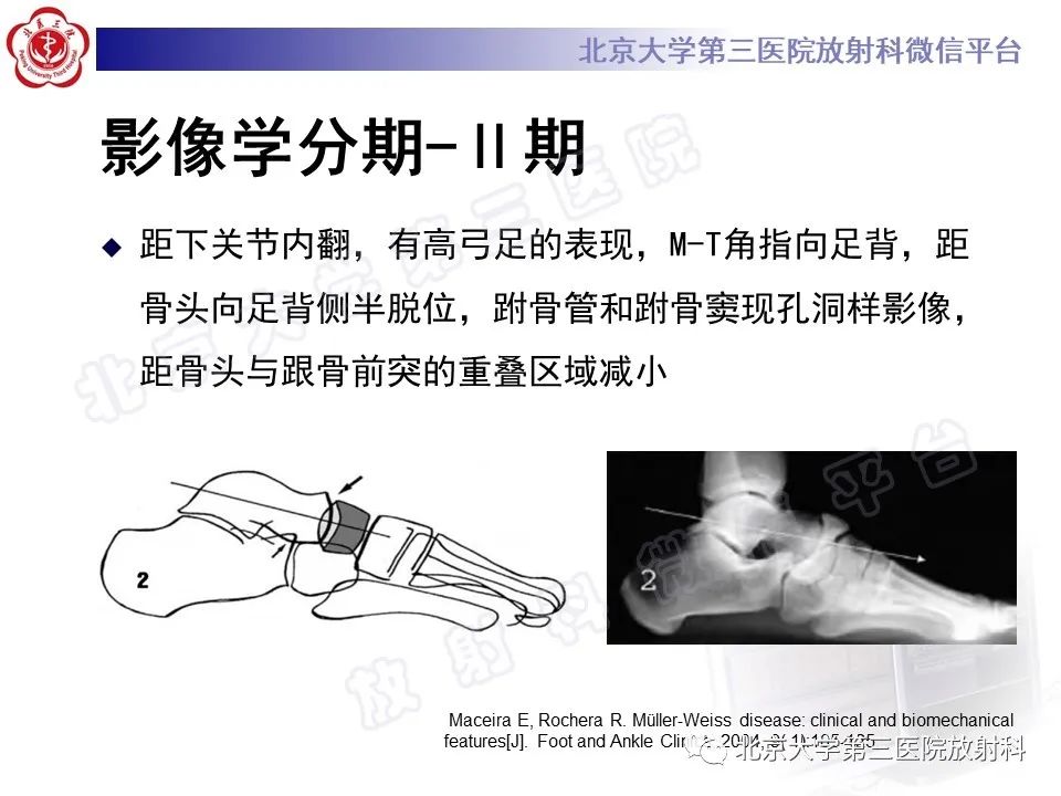 影像PPT - 【PPT】足舟骨缺血坏死-30