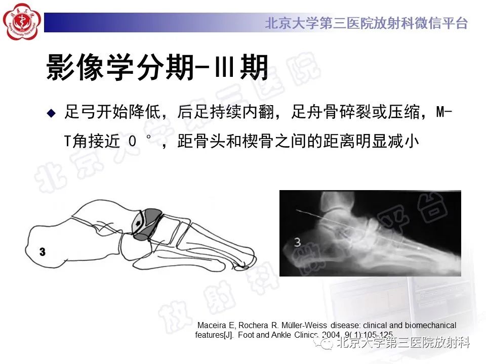影像PPT - 【PPT】足舟骨缺血坏死-31