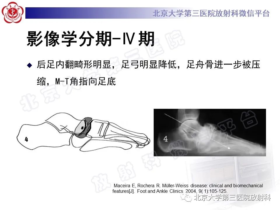 影像PPT - 【PPT】足舟骨缺血坏死-32