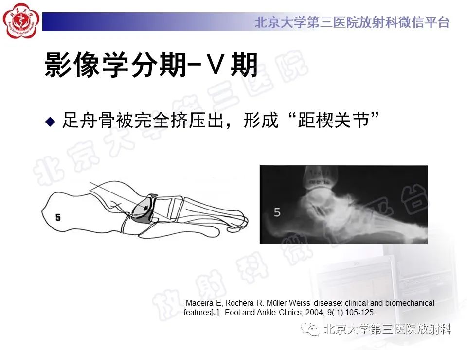 影像PPT - 【PPT】足舟骨缺血坏死-33