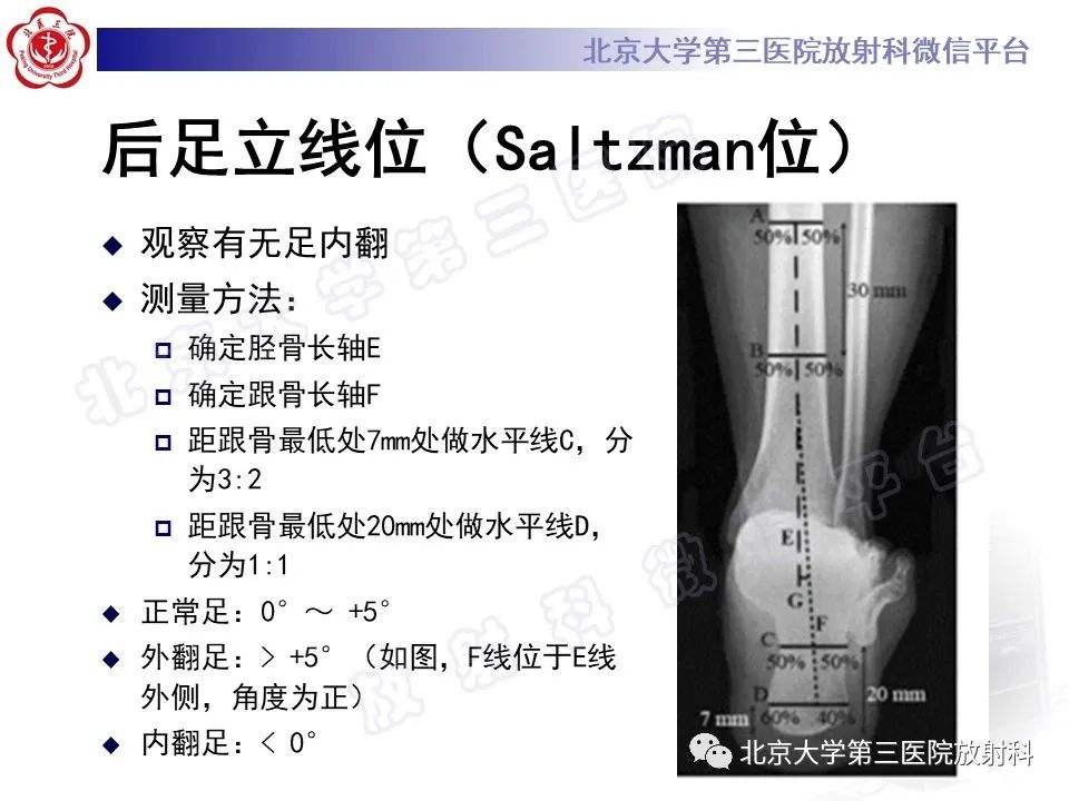 影像PPT - 【PPT】足舟骨缺血坏死-34