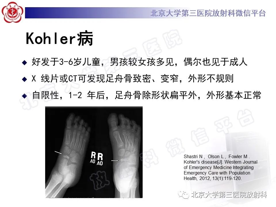 影像PPT - 【PPT】足舟骨缺血坏死-38