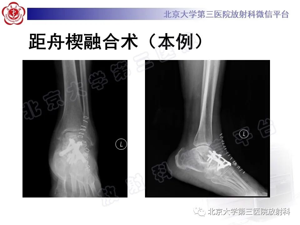 影像PPT - 【PPT】足舟骨缺血坏死-41