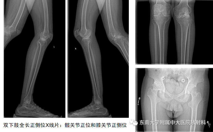 影像PPT - 【PPT】血友病性骨关节炎-1 影像PPT - 【PPT】血友病性骨关节炎-1