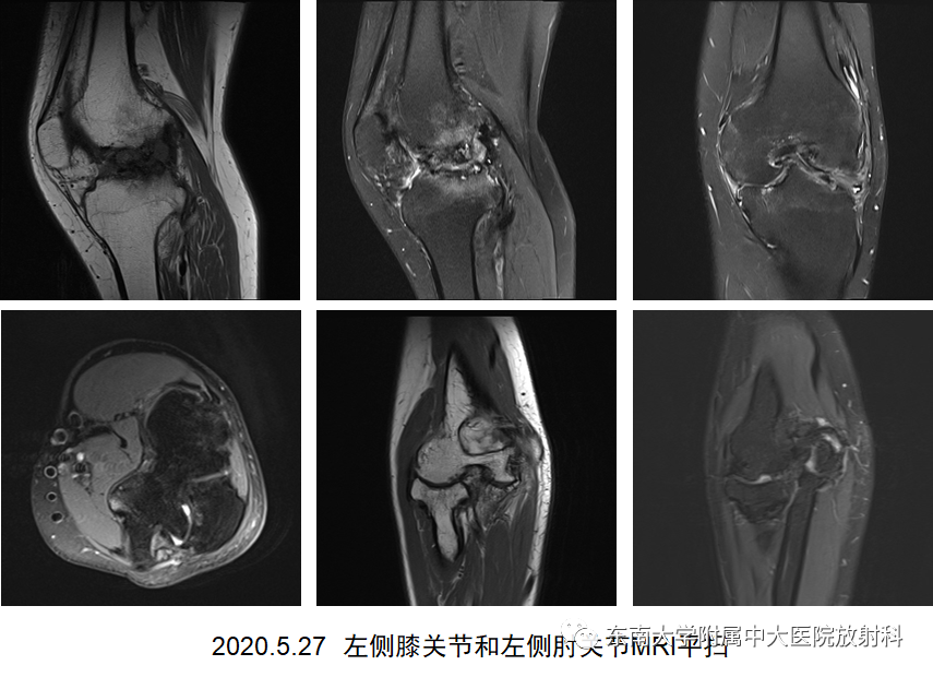 影像PPT - 【PPT】血友病性骨关节炎-3 影像PPT - 【PPT】血友病性骨关节炎-3