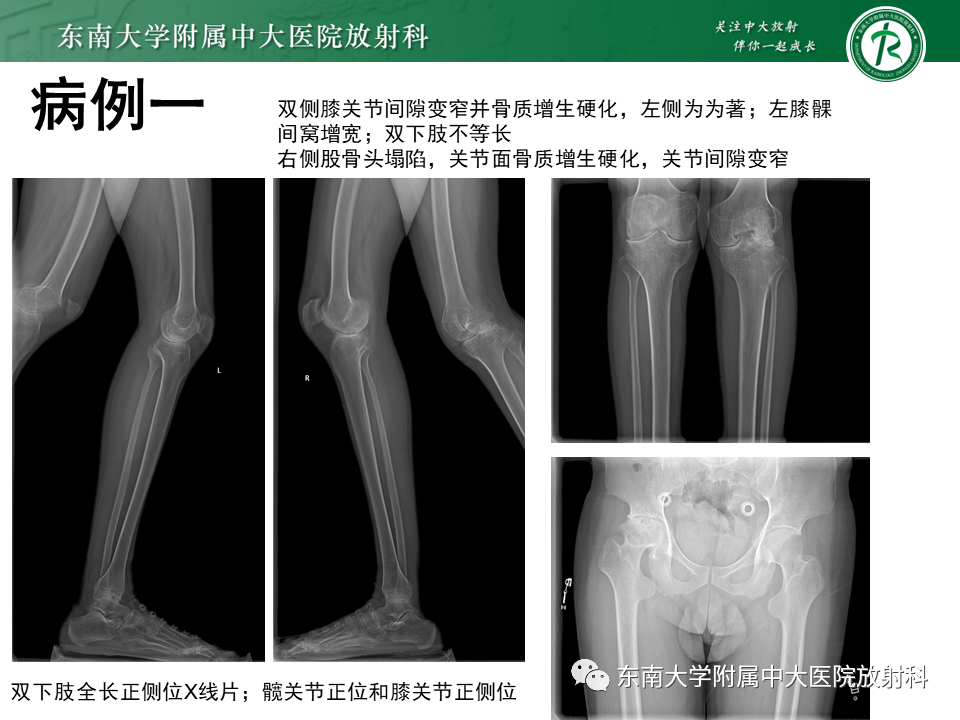 影像PPT - 【PPT】血友病性骨关节炎-4 影像PPT - 【PPT】血友病性骨关节炎-4