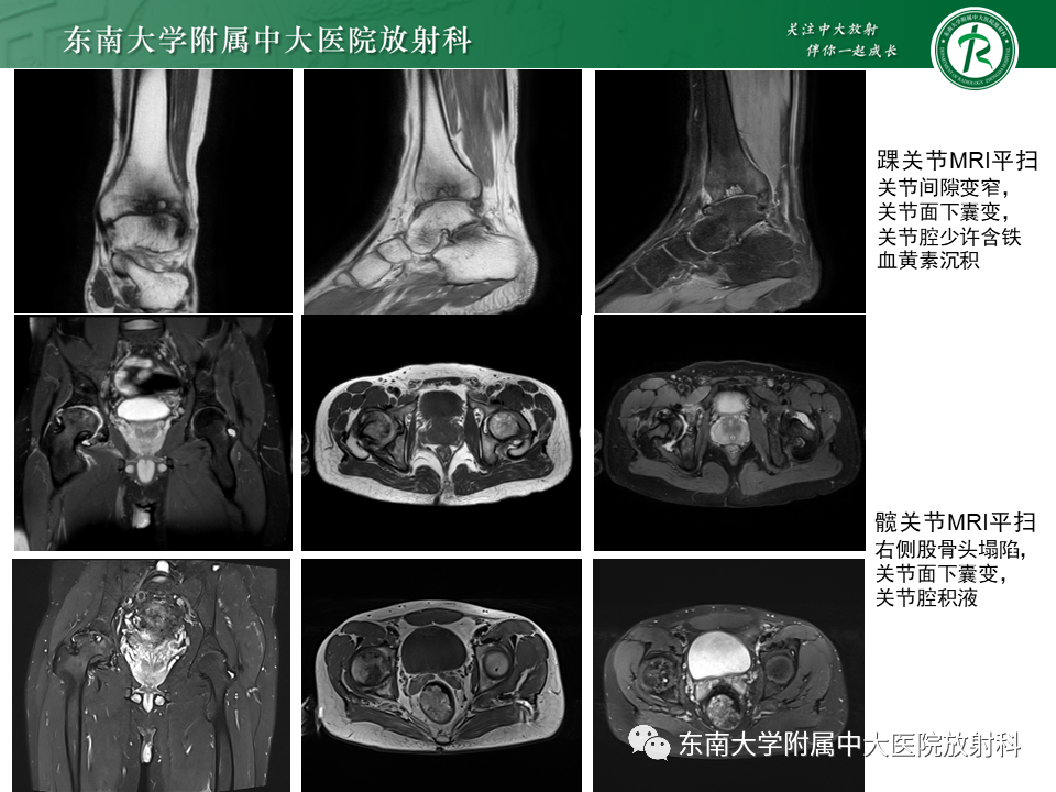 影像PPT - 【PPT】血友病性骨关节炎-5 影像PPT - 【PPT】血友病性骨关节炎-5