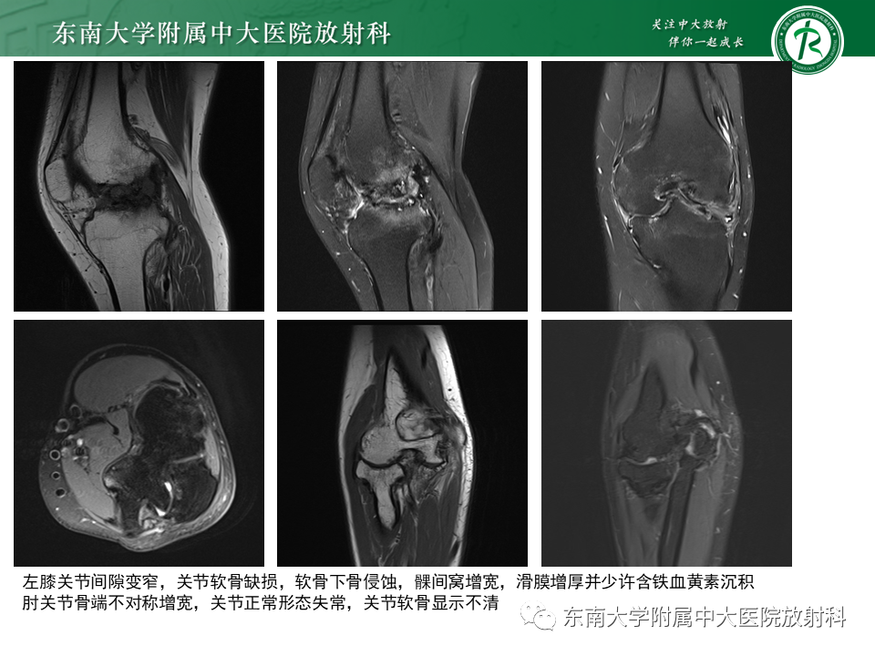 影像PPT - 【PPT】血友病性骨关节炎-6 影像PPT - 【PPT】血友病性骨关节炎-6