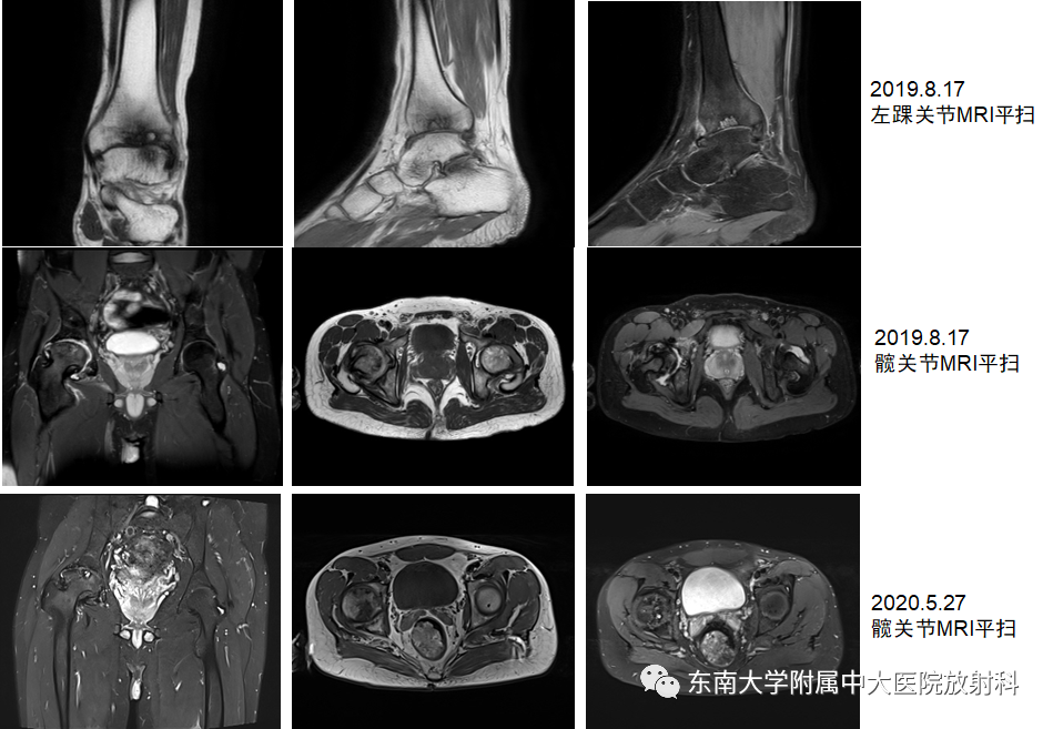 影像PPT - 【PPT】血友病性骨关节炎-2 影像PPT - 【PPT】血友病性骨关节炎-2