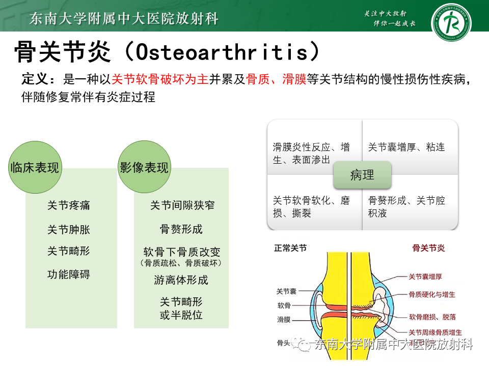 影像PPT - 【PPT】血友病性骨关节炎-9 影像PPT - 【PPT】血友病性骨关节炎-9