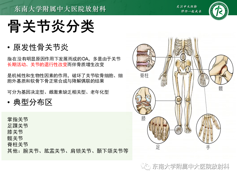影像PPT - 【PPT】血友病性骨关节炎-11 影像PPT - 【PPT】血友病性骨关节炎-11