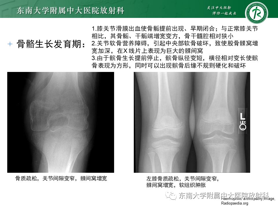 影像PPT - 【PPT】血友病性骨关节炎-19 影像PPT - 【PPT】血友病性骨关节炎-19