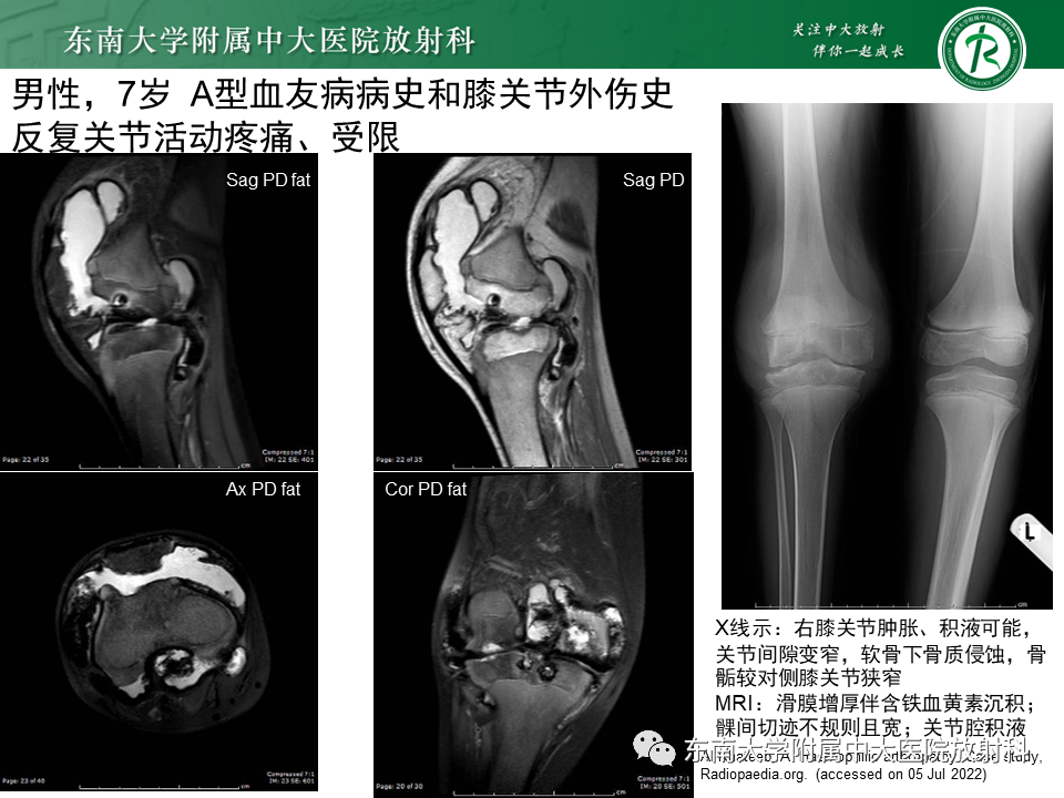 影像PPT - 【PPT】血友病性骨关节炎-20 影像PPT - 【PPT】血友病性骨关节炎-20