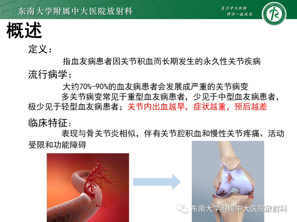 影像PPT - 【PPT】血友病性骨关节炎-8 影像PPT - 【PPT】血友病性骨关节炎-8