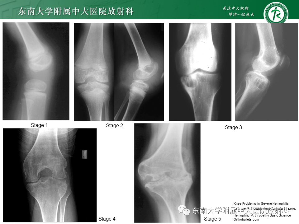 影像PPT - 【PPT】血友病性骨关节炎-22 影像PPT - 【PPT】血友病性骨关节炎-22