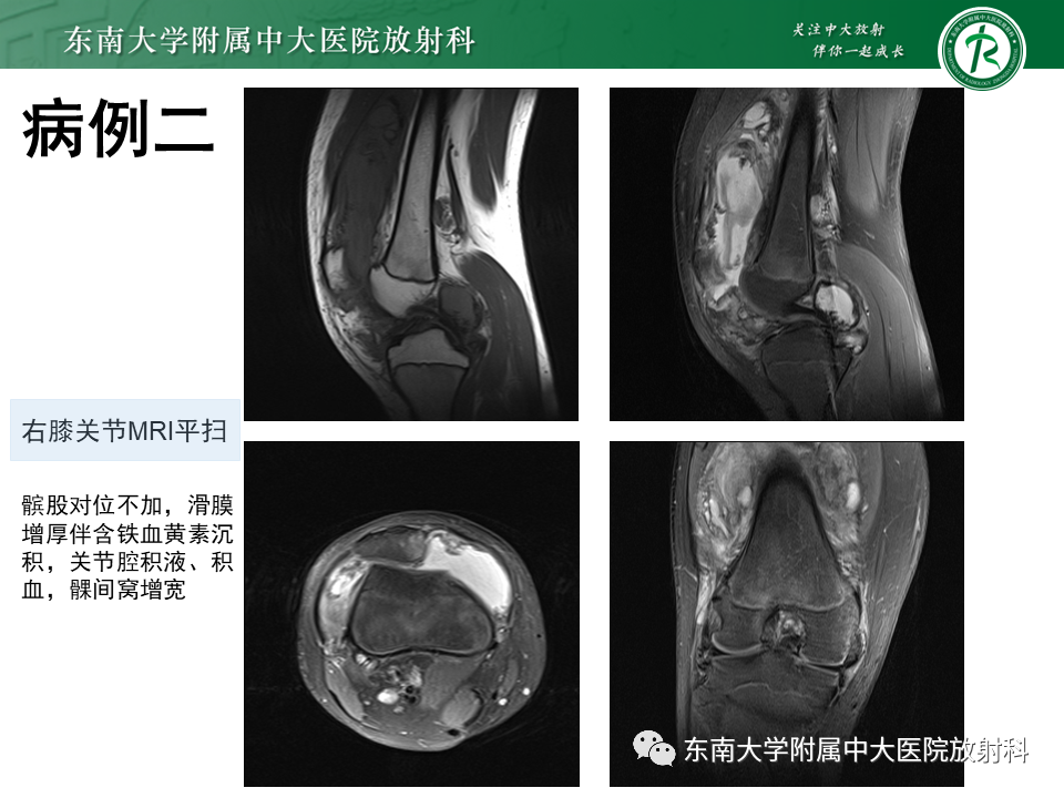影像PPT - 【PPT】血友病性骨关节炎-25 影像PPT - 【PPT】血友病性骨关节炎-25