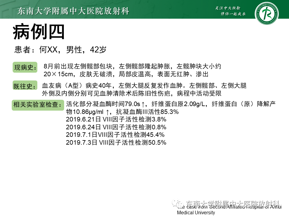 影像PPT - 【PPT】血友病性骨关节炎-29 影像PPT - 【PPT】血友病性骨关节炎-29