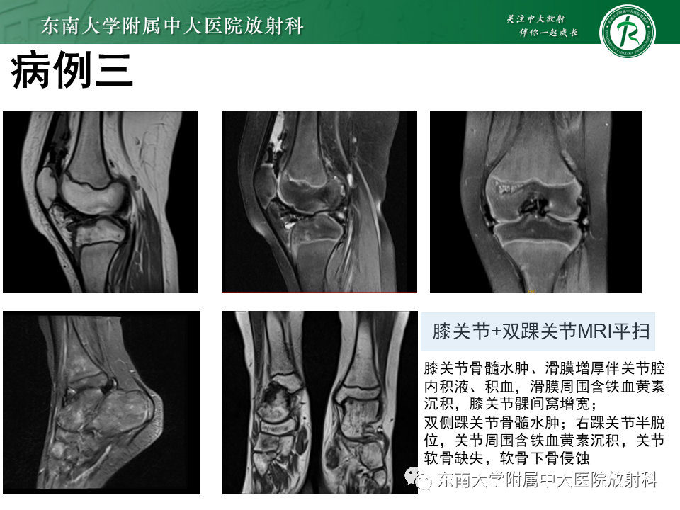 影像PPT - 【PPT】血友病性骨关节炎-28 影像PPT - 【PPT】血友病性骨关节炎-28