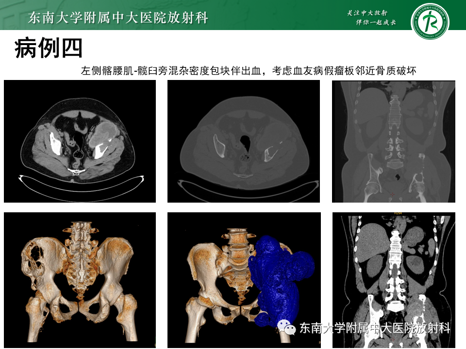 影像PPT - 【PPT】血友病性骨关节炎-30 影像PPT - 【PPT】血友病性骨关节炎-30