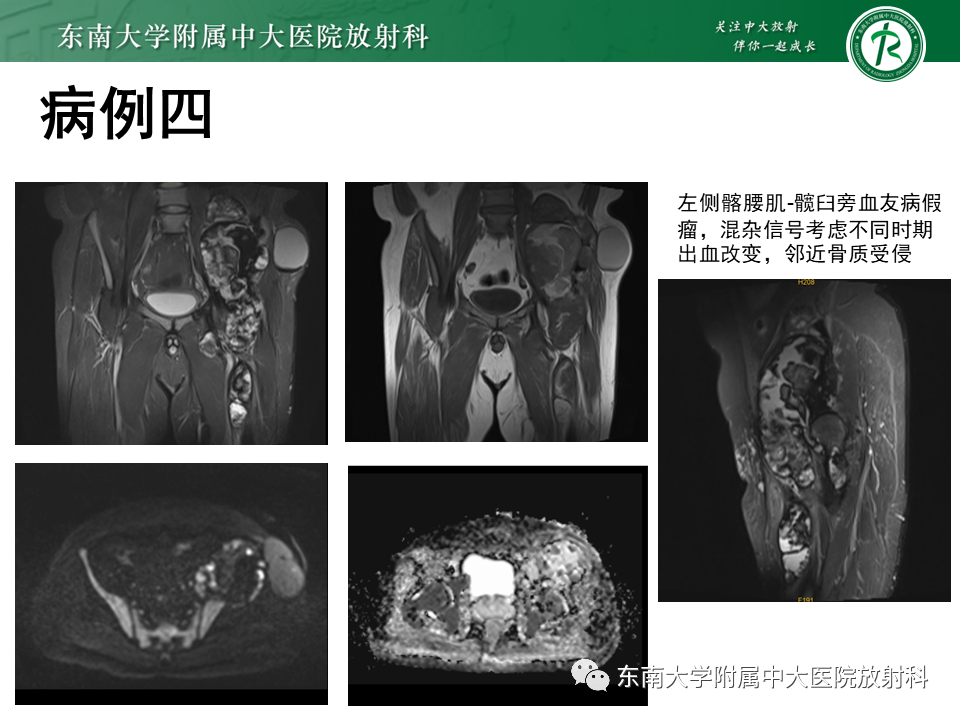 影像PPT - 【PPT】血友病性骨关节炎-31 影像PPT - 【PPT】血友病性骨关节炎-31
