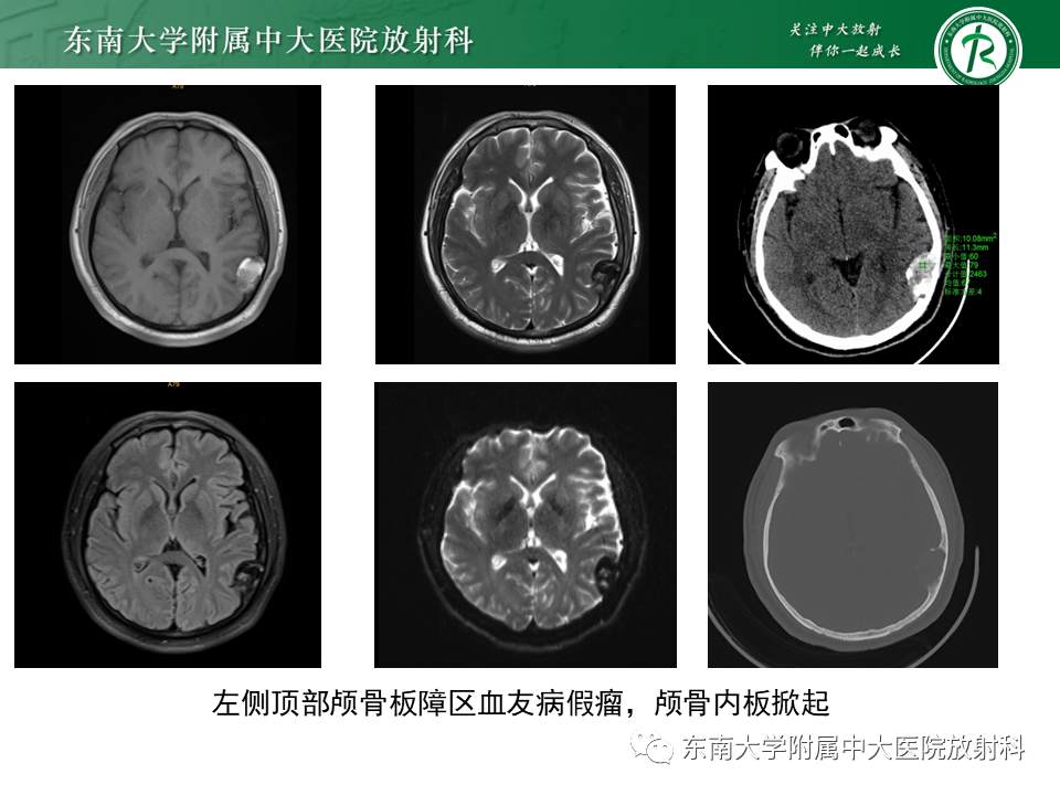 影像PPT - 【PPT】血友病性骨关节炎-32 影像PPT - 【PPT】血友病性骨关节炎-32
