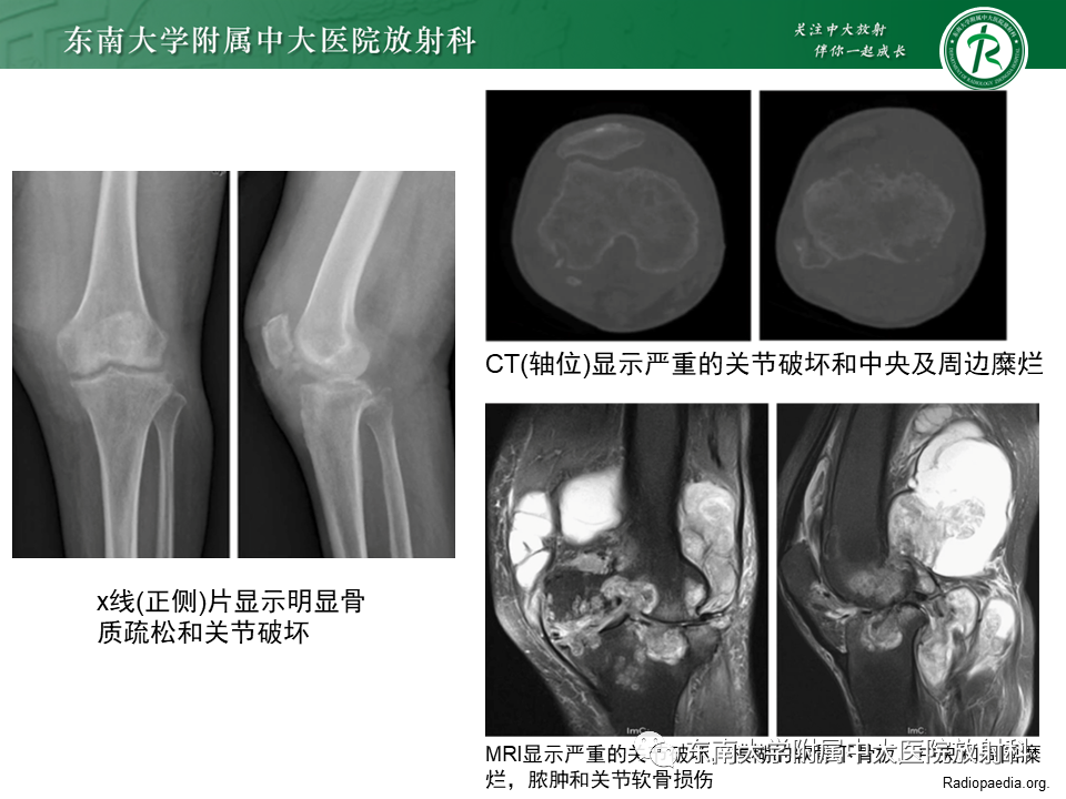 影像PPT - 【PPT】血友病性骨关节炎-37 影像PPT - 【PPT】血友病性骨关节炎-37