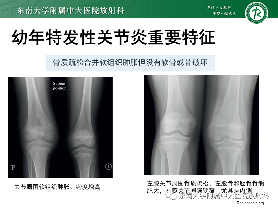 影像PPT - 【PPT】血友病性骨关节炎-41 影像PPT - 【PPT】血友病性骨关节炎-41
