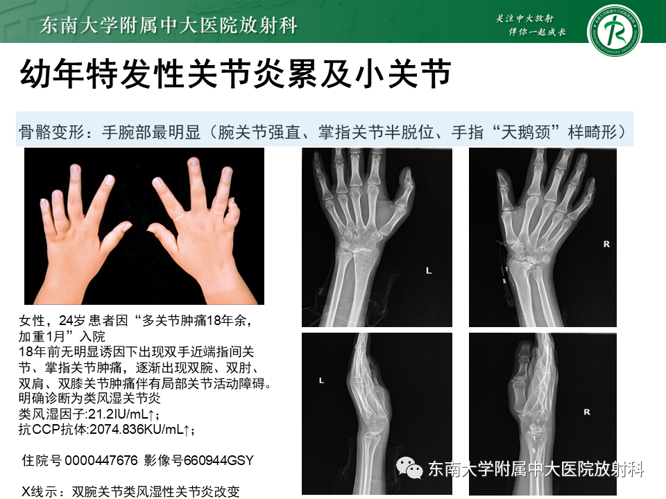 影像PPT - 【PPT】血友病性骨关节炎-42 影像PPT - 【PPT】血友病性骨关节炎-42