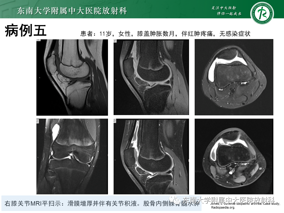 影像PPT - 【PPT】血友病性骨关节炎-43 影像PPT - 【PPT】血友病性骨关节炎-43
