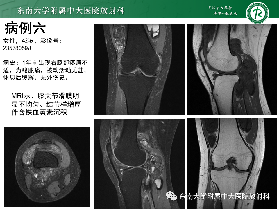 影像PPT - 【PPT】血友病性骨关节炎-46 影像PPT - 【PPT】血友病性骨关节炎-46