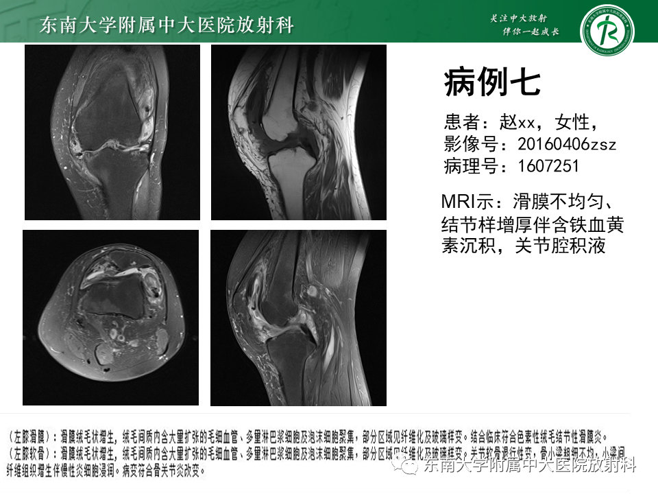 影像PPT - 【PPT】血友病性骨关节炎-47 影像PPT - 【PPT】血友病性骨关节炎-47