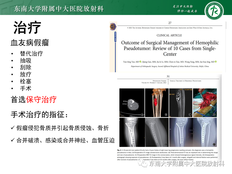 影像PPT - 【PPT】血友病性骨关节炎-49 影像PPT - 【PPT】血友病性骨关节炎-49