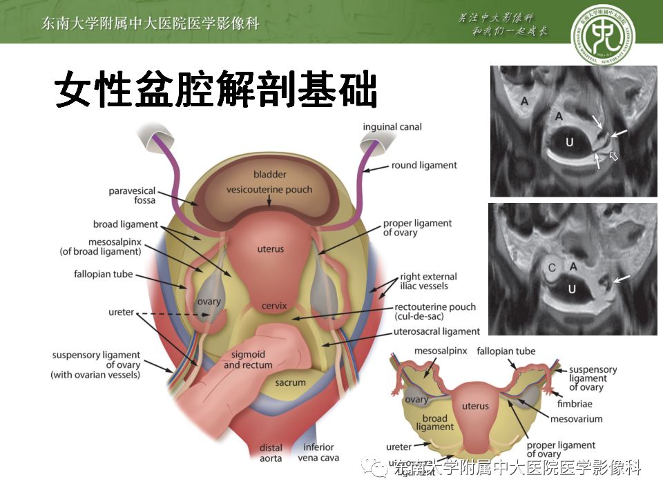 影像PPT - 【病例】双侧输卵管脓肿1例MR影像-11