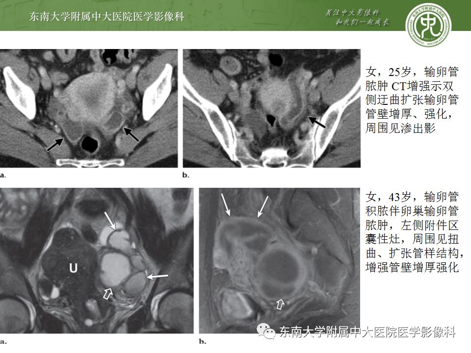 影像PPT - 【病例】双侧输卵管脓肿1例MR影像-14