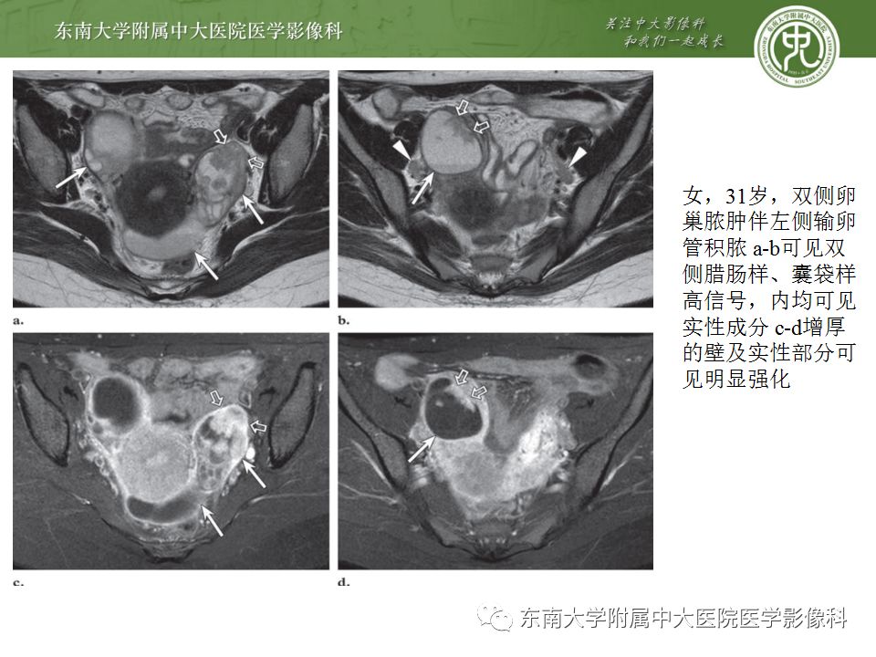 影像PPT - 【病例】双侧输卵管脓肿1例MR影像-15