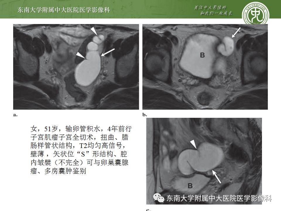 影像PPT - 【病例】双侧输卵管脓肿1例MR影像-16