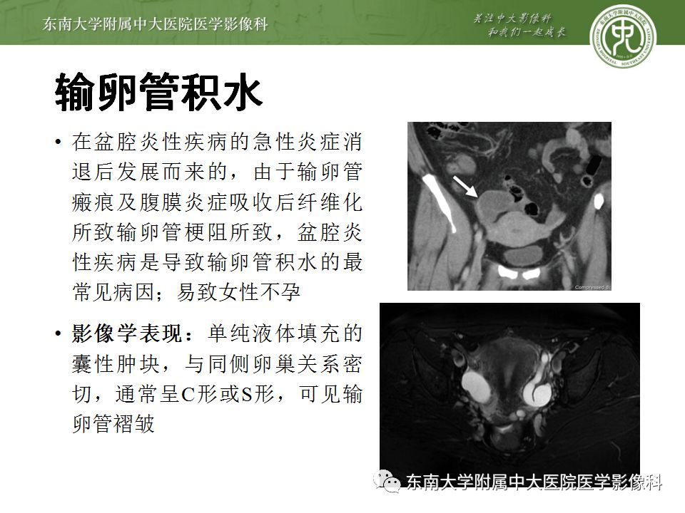 影像PPT - 【病例】双侧输卵管脓肿1例MR影像-17