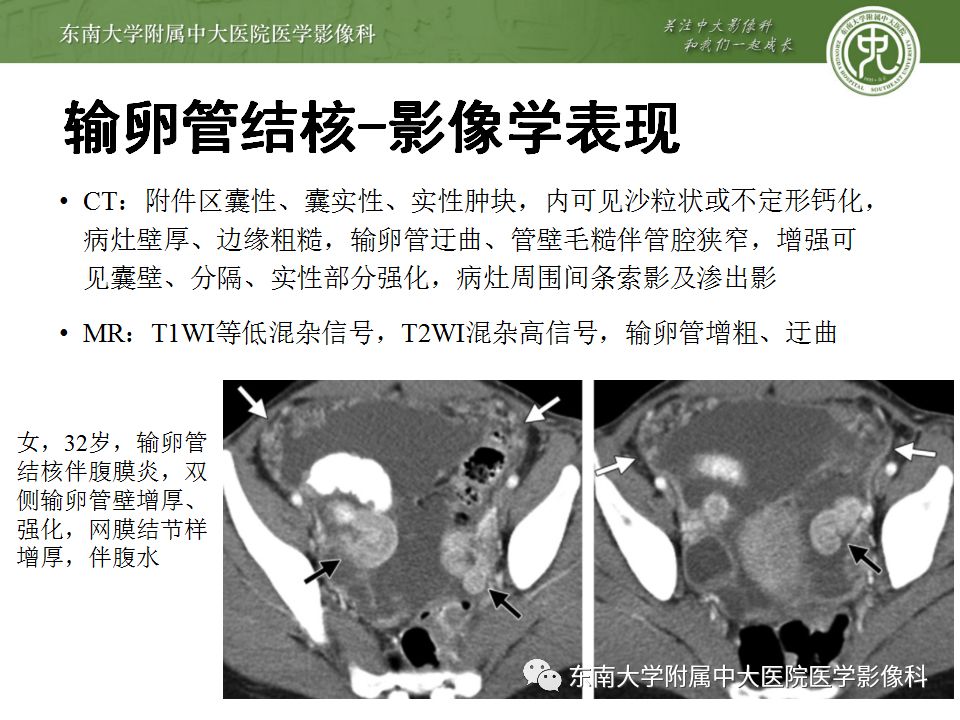 影像PPT - 【病例】双侧输卵管脓肿1例MR影像-19