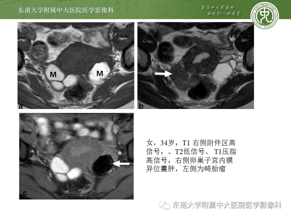 影像PPT - 【病例】双侧输卵管脓肿1例MR影像-21