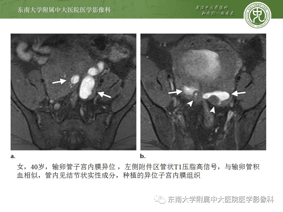 影像PPT - 【病例】双侧输卵管脓肿1例MR影像-22