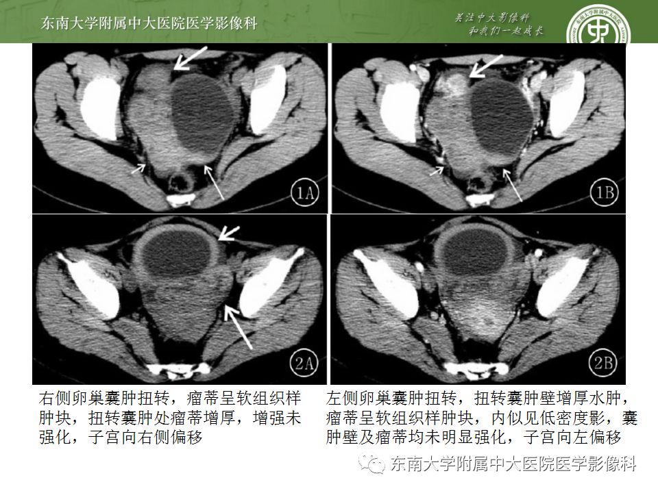 影像PPT - 【病例】双侧输卵管脓肿1例MR影像-24