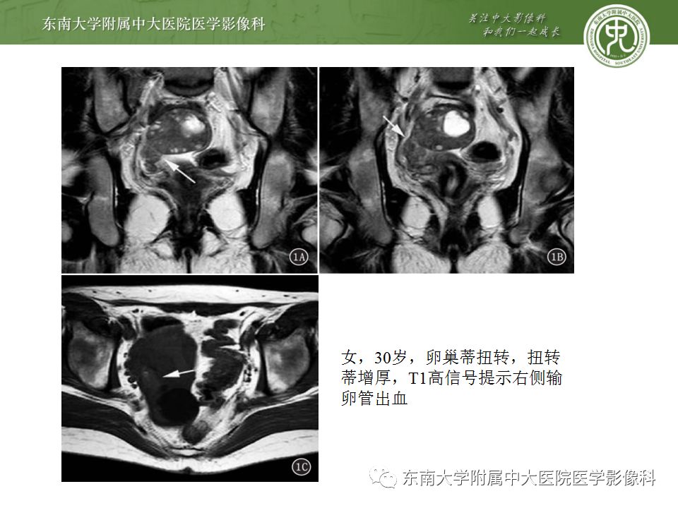 影像PPT - 【病例】双侧输卵管脓肿1例MR影像-25