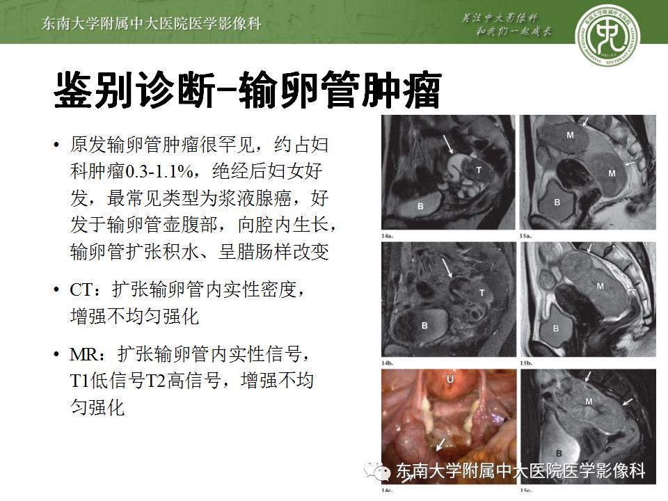 影像PPT - 【病例】双侧输卵管脓肿1例MR影像-26