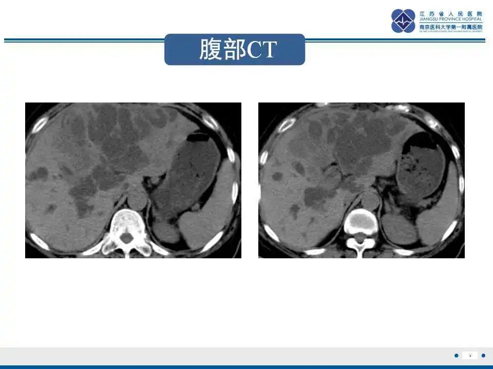 影像PPT - 【PPT】特鲁索综合征 Trousseau snydrome-3