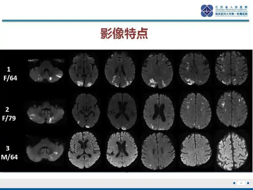 影像PPT - 【PPT】特鲁索综合征 Trousseau snydrome-22