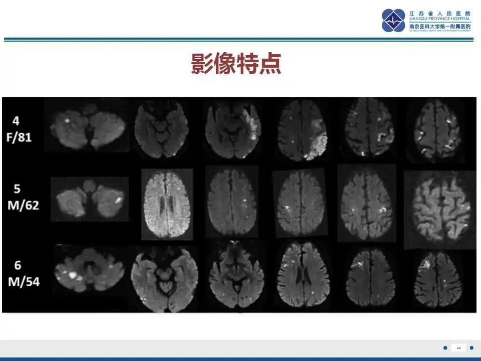 影像PPT - 【PPT】特鲁索综合征 Trousseau snydrome-23