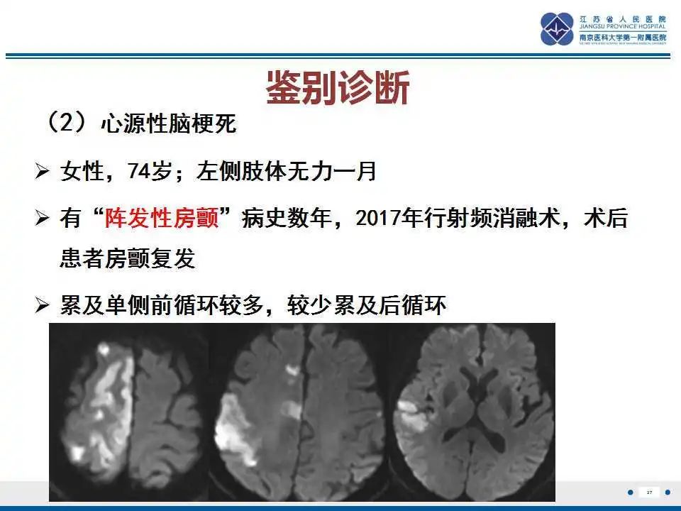 影像PPT - 【PPT】特鲁索综合征 Trousseau snydrome-28